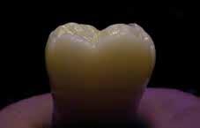 Auch diese Eigenschaft trägt zum hochästhetischen Erscheinungsbild von Provisorien aus bei, die in ihrer Natürlichkeit nur schwer vom menschlichen Zahn zu unterscheiden sind.