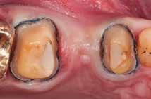 kariösen Dentins