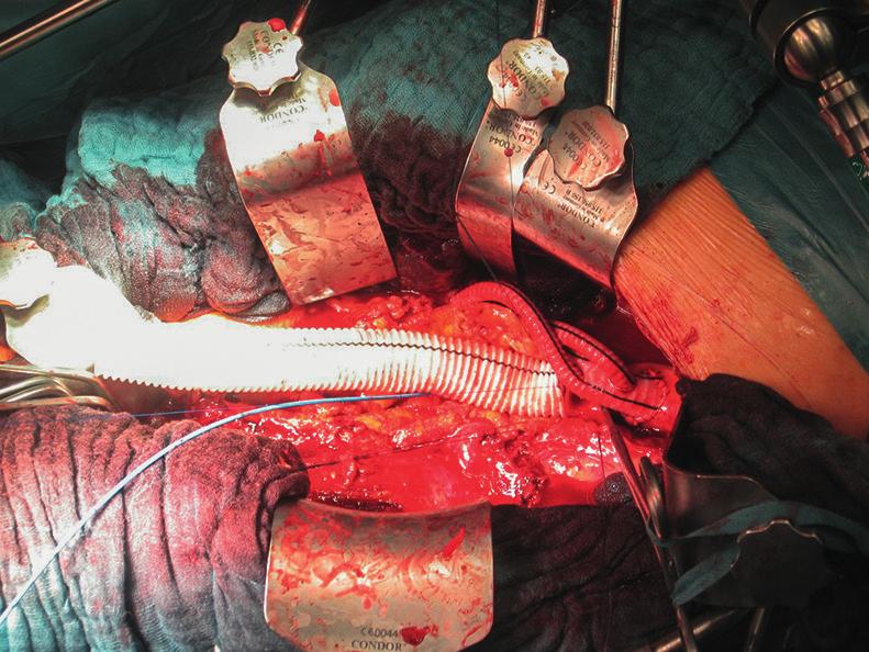 distal der proximalen Bypassanastomose beginnt. In dieses Interponat wird das Ostium der rechten Nierenarterie implantiert ( Abb. 15). Abb. 16 Freigelegte thorakoabdominelle Aorta.