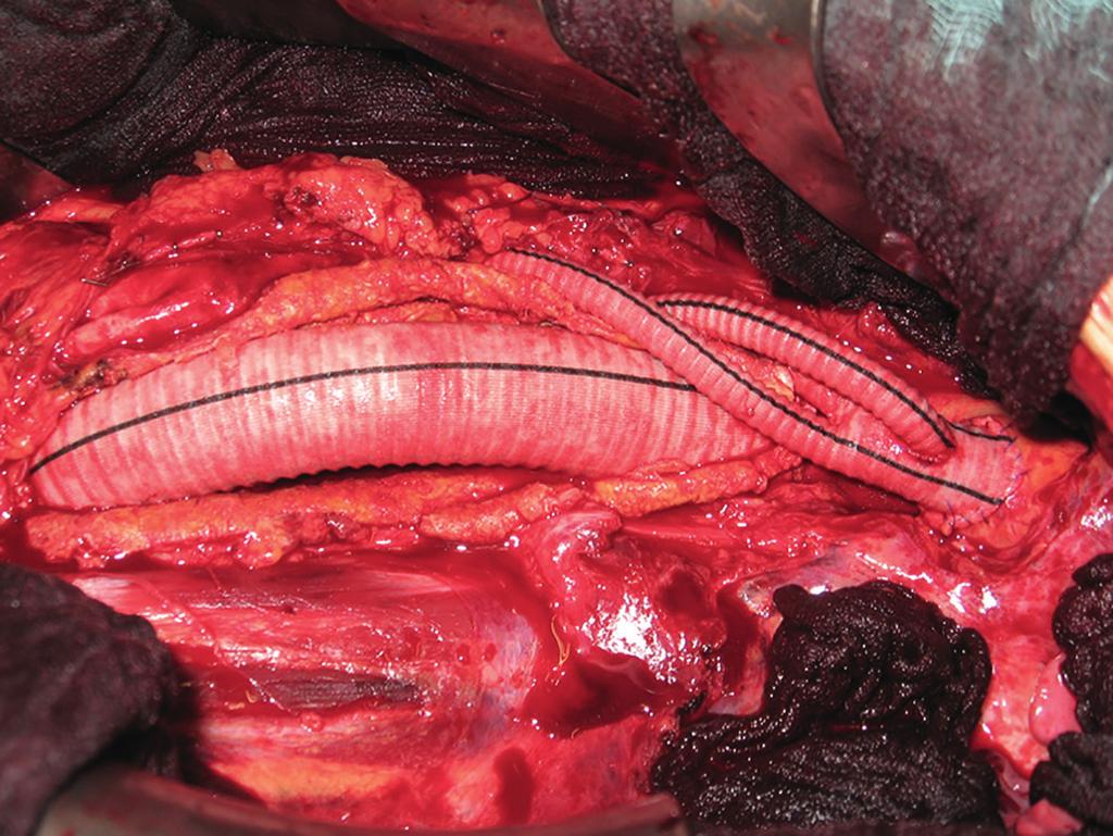 Abb. 18 Fertiggestelltes Aorteninterponat; die Anastomose zur rechten Nierenarterie befindet sich auf der Rückseite der Prothese Typ 3-Aneurysmen versorgen wir standardmäßig in der Ballard-Technik