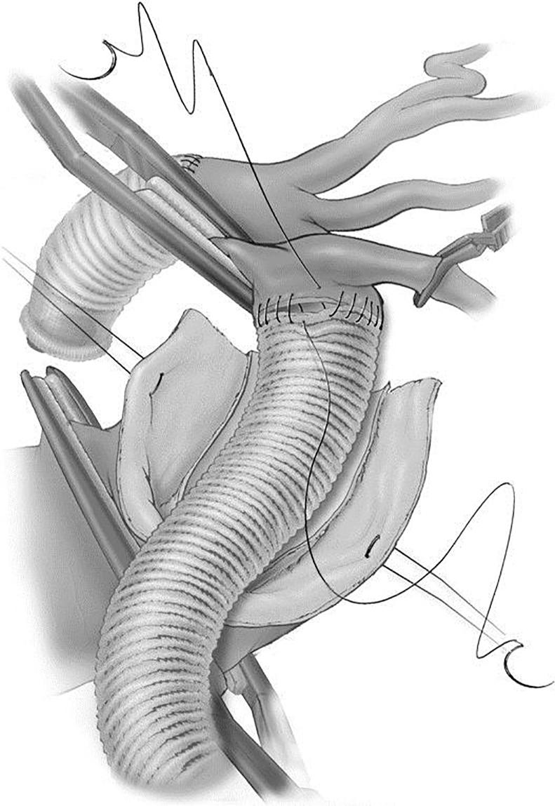 Die Aorta wird proximal quer geklemmt, im Bereich des Aneurysmas gegengeklemmt, eröffnet und in Höhe der geplanten Anastomose komplett durchtrennt. Interkostalarterien werden hier umstochen.