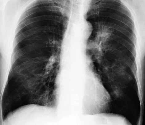 COPD (z. B. Raucherhusten ) oder Lungenemphysem, mit allgemeiner Abwehrschwäche, wie z. B. bei HIV-Infektion, Menschen mit Allergien sowie sehr alte Menschen und kleine Kinder.
