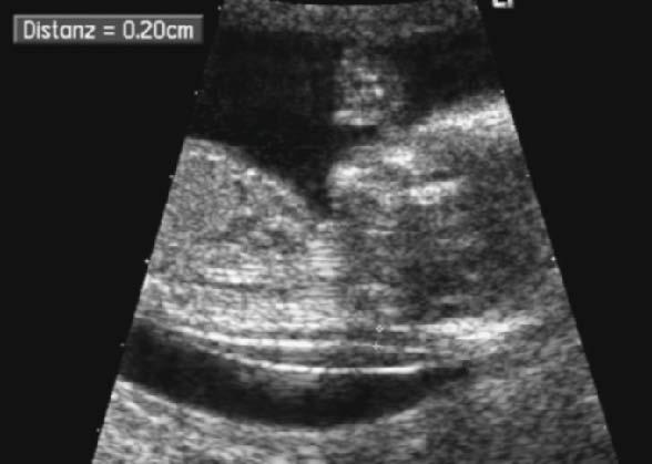 Bei sehr adipösen Schwangeren oder retroflektiertem Uterus kann die vaginalsonographische Untersuchung notwendig werden, meist ist jedoch die transabdominale Sonographie aussagekräftig genug.