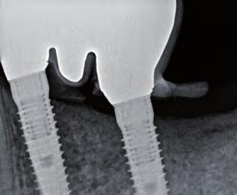 IIa, Farbe: natural opaque implantlink semi Xray Semipermanenter Implantatzement auf Kunststoffbasis 4:1, zur Befestigung von Suprakonstruktionen.