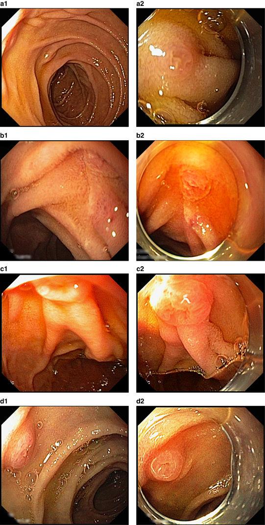 Cap Assisted Upper Endoscopy for Examination of the Major Duodenal Papilla: A Randomized, Blinded, Controlled Crossover Study (CAPPA Study) Abdelhafez, Am J Gastroenterol 2017!