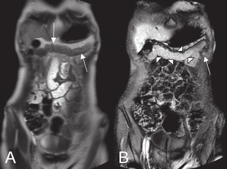 Anhang: Fallbeispiele Fall 1: Patientin mit Morbus Crohn: (a d) konsekutive Schichten in 6-mm-Abstand durch das terminale Ileum (3D-GRE).