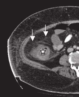 (a, b) Interenterische Fistel (Pfeilspitzen). (d) Dilatierter proximaler intestinaler Abschnitt (Stern). Fall 2: Patient mit Colitis ulcerosa.