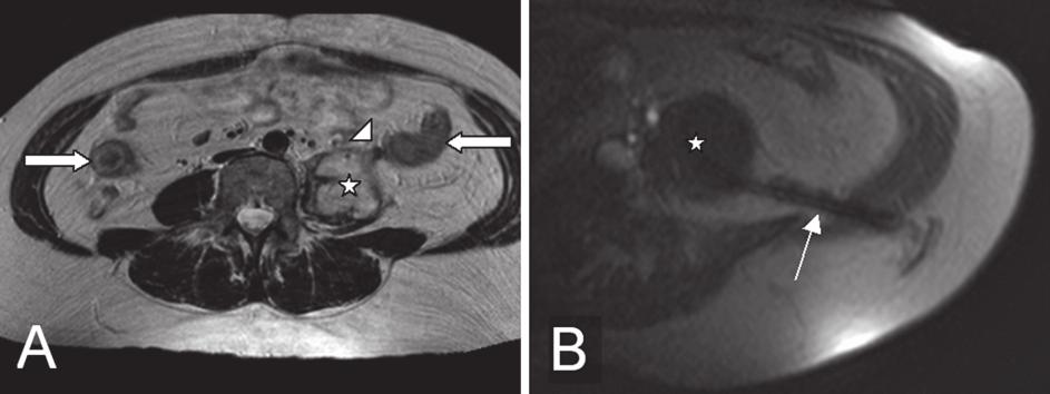 Fall 4: Patientin mit beidseitigen Psoasabszessen bei Mb. Crohn. Ursächlich ist eine enteroretroperitoneale Fistel (nicht dargestellt). (a) Flüssigkeitsisointense Kappen über den Mm.