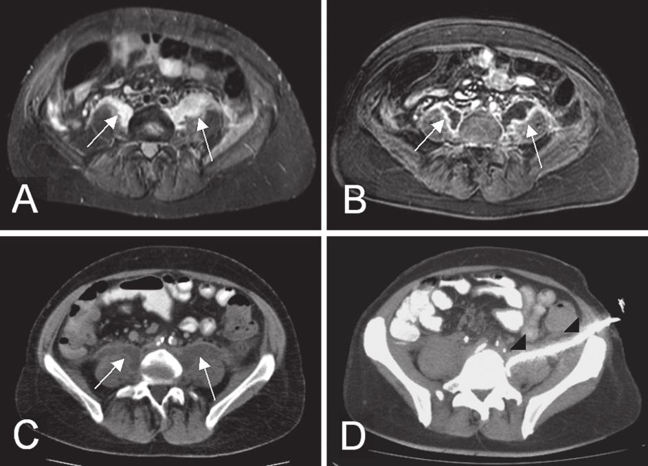 (c) Das korrespondierende CT mit Kontrastmittel zeigt ebenfalls die beschriebenen Abszessformationen (Pfeile). (d) CT-fluoroskopische Einlage einer Drainage (Pfeilspitzen).