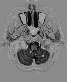 inferior posterior cerebelli (PICA) 14 Lemniscus medialis 15 N. hypoglossus (innerhalb der Scheibe) 16 Nuclei olivares inferiores 17 Tr.