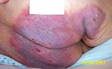 Windel-Dermatitis - Ekzem