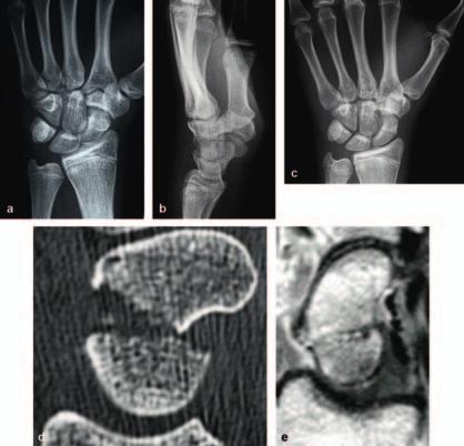 120 Hand und Finger Abb..9 Kahnbeinfraktur: a Röntgen Handgelenk a.-p. b Röntgen Handgelenk seitlich c Röntgen Handgelenk a.-p. ulnarduziert nach Stecher d CT e MRT [M706] Tab.