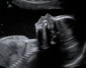 Magnesiumsulfat Als Neuroprotektivum Wer? Schwangere vor der 32. SSW PPROM vorzeitige WT und intakte Membranen mit drohender FG Geburt innerhalb 24 Std.