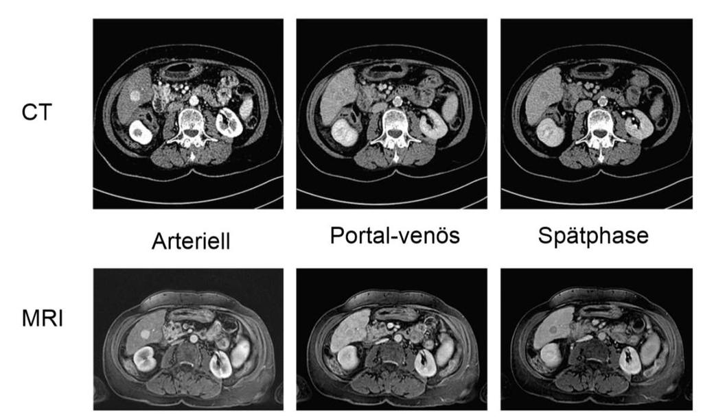 KM-unterstützten CT/US oder MRI Hypervaskularität in arterieller