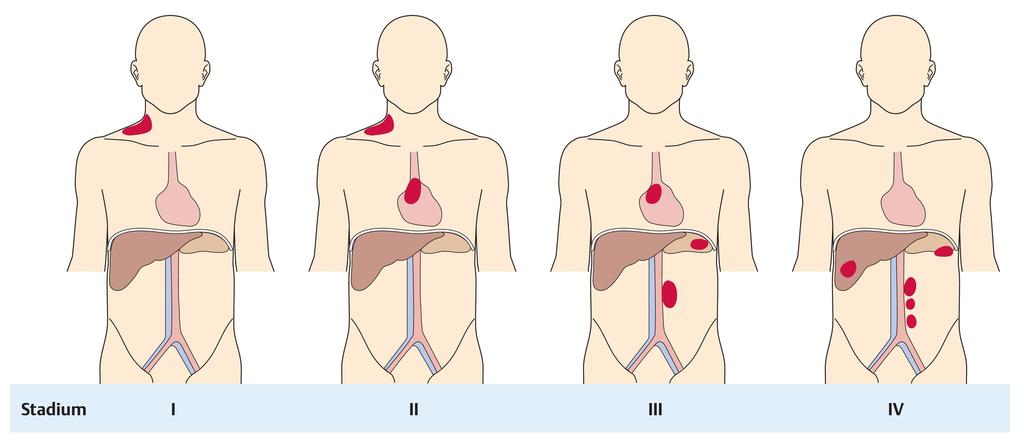Indolente Lymphome Diagnostik Stadium I: Befall einer Lymphknotenstation Stadium II: Befall von 2 Lymphknotenstationen auf einer Seite des Zwerchfells Stadium III: Befall von