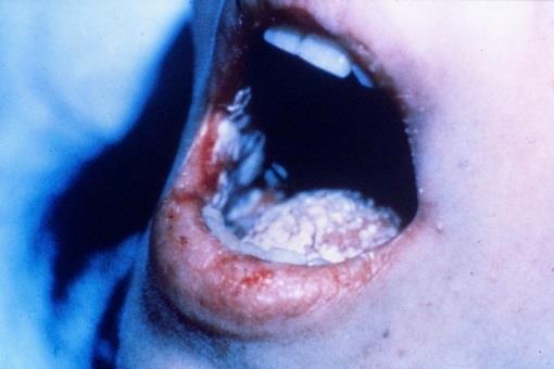 SOOR Infektion der Schleimhäute (Mund, Vagina). An der Schleimhaut bildet sich ein grau-weißlicher Belag; ist die Haut betroffen, kommt es zu schuppenden, entzündlichen Veränderungen.