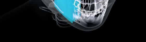 überzähligen Zähnen Erkennen der apikalen Läsionen innerhalb eines bestimmten anatomischen Schnitts für eine bessere Diagnose Erkennen der Lage der Wurzel zum unteren