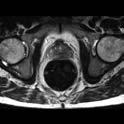 Durchblutung des Tumors: Dynamische MRT mit