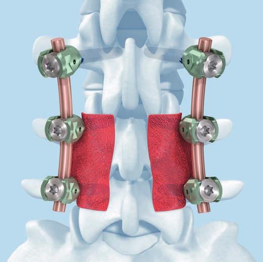 Biomaterial-Implantate Zur Begünstigung und Förderung der Fusion wird häufig Knochentransplantat in die lateralen Rinnen eingebracht. Ein geeignetes Knochenersatzmaterial (z. B. chronos, DBX) kann allein oder in Kombination mit Autotransplantat verwendet werden.