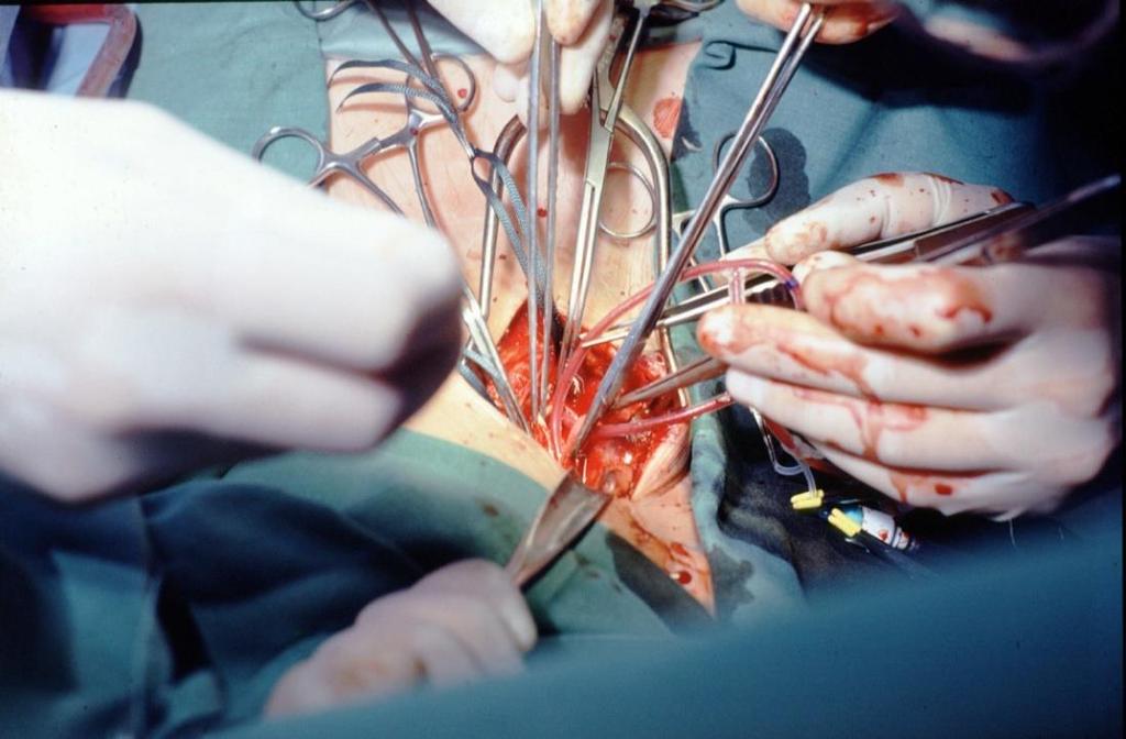 Karotischirurgie: Shuntanlage