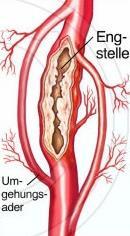 Arterielle Eingriffe: Periop.