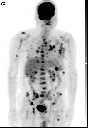 Melanom am Rücken links 11/02, 12/02 und 2/03 jeweils Metastasen aus
