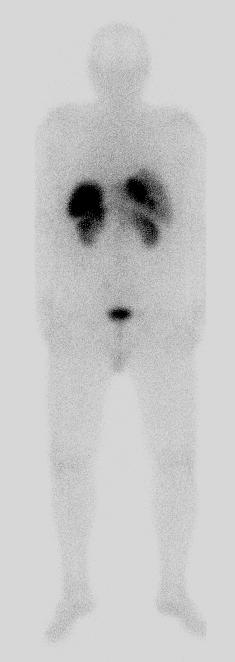 Punktion Leberherde Karzinoid, RF 3 x 5 cm im Pankreasschwanz CT des