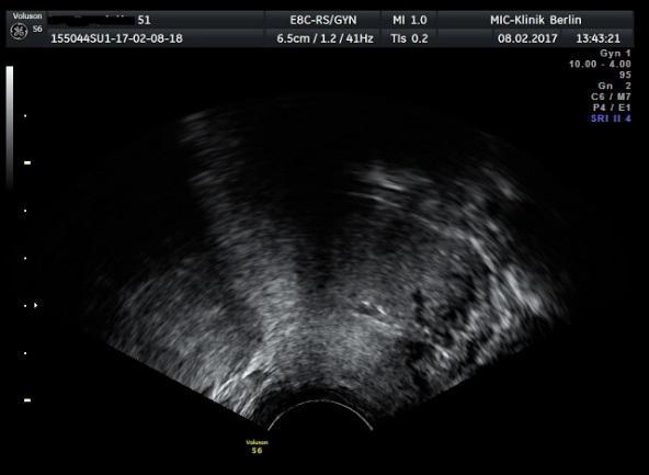 Fall 1: 51 Jahre, Mehrknolliger Uterus