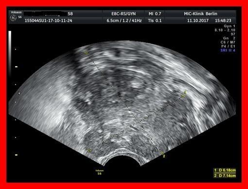 Fall 3: 58 Jahre, Großer Mehrknolliger Uterus myomatosus, Zustand