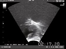 Wissenschaftlich erwiesen 2 : Der NaturalWave Sauger ermöglicht dem Baby, sein an der Brust erlerntes Saugmuster beizubehalten Eine Ultraschall-Studie der Universität Leeds (LUIS 2, Woolridge et