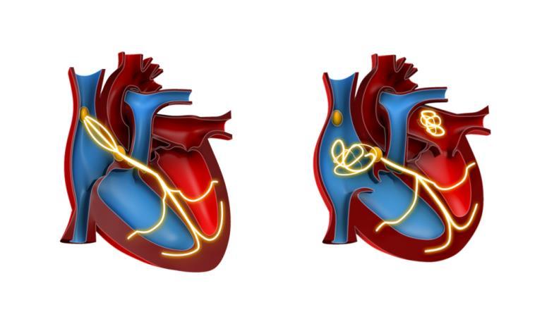 Bei VHF keine Kontrolle des Herzrhythmus durch den Sinusknoten Sinusrhythmus Vorhofflimmern Sinusknoten Abnormale elektrische Leitungsbahnen