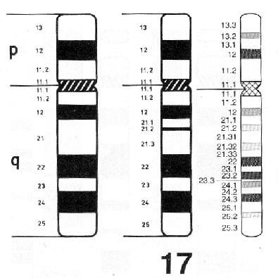 Das Miller-Dieker-Syndrom wird verursacht durch Verlust des terminalen Abschnittes des kurzen Armes von Chromsom 17 (Bande 17p13.3).
