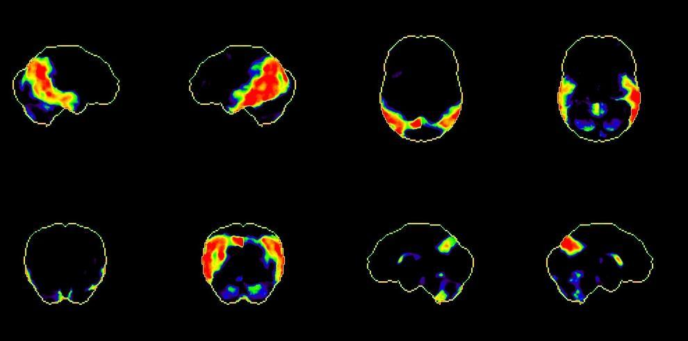 Kartierung der differentiellen Aktivität von Hirnregionen von Alzheimer Patienten gegenüber einer