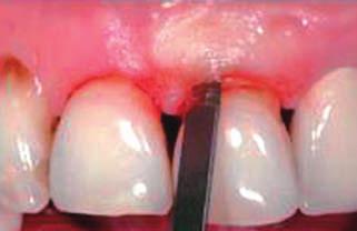 b) Nach okaer Anästhesie erfogt eine intrasukuäre Inzision um die Zähne