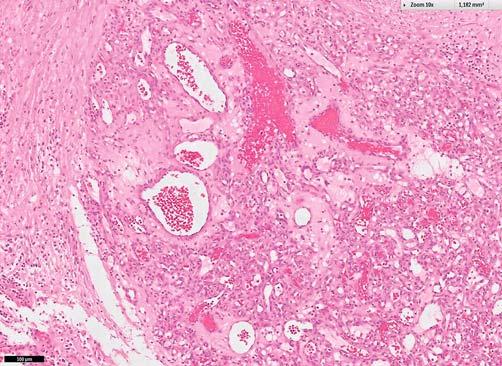 Abb. 1 Histologie des Granuloma pyogenicum, HE 10. oberflächlicher Krustenbildung. Die Therapie wurde für weitere 3 Wochen 3-mal wöchentlich fortgeführt.
