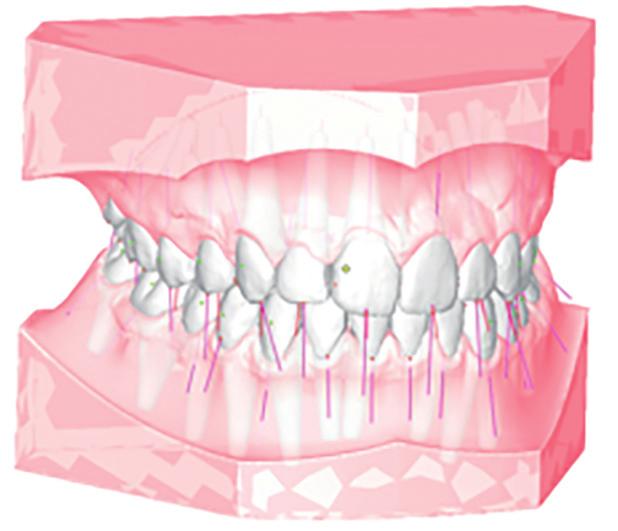 In OnyxCeph3 TM gesockelter und segmentierter 3M TM True Definition Intraoralscan Onyx Ceph (Image Instruments) Zur 2-D-/3-D-Analyse nutzen wir in unserer Praxis die Planungssoftware Onyx Ceph (Fa.