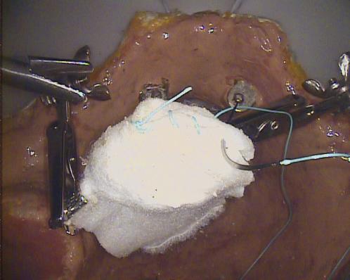 Naht- und Knotentechniken in einer originalgetreuen Situation Das Tool besteht aus zwei Haltevorrichtung sowie einem Klemmsystem für die vaginale Arretierung (optional).