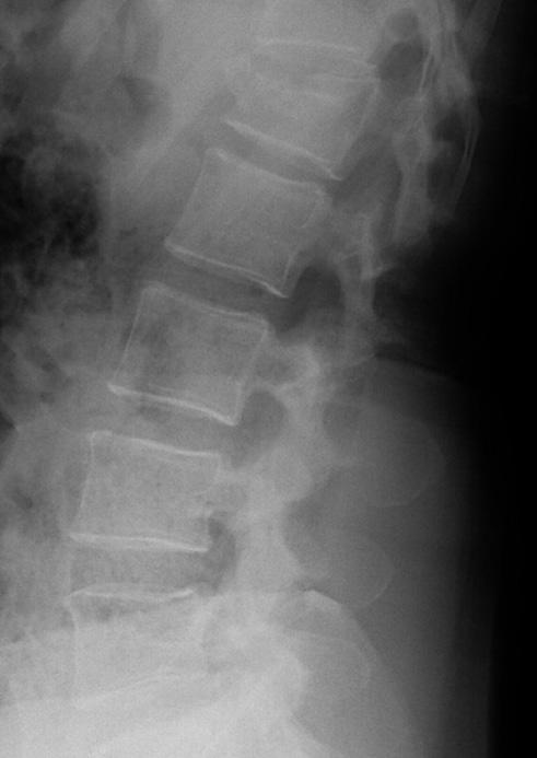 Der Anwendungsbereich bei Patienten mit Traumata oder Tumorerkrankungen liegt normalerweise am thorakolumbalen Übergang (T12/L1), kann aber von T6 bis zum Sacrum (S1) erweitert werden.