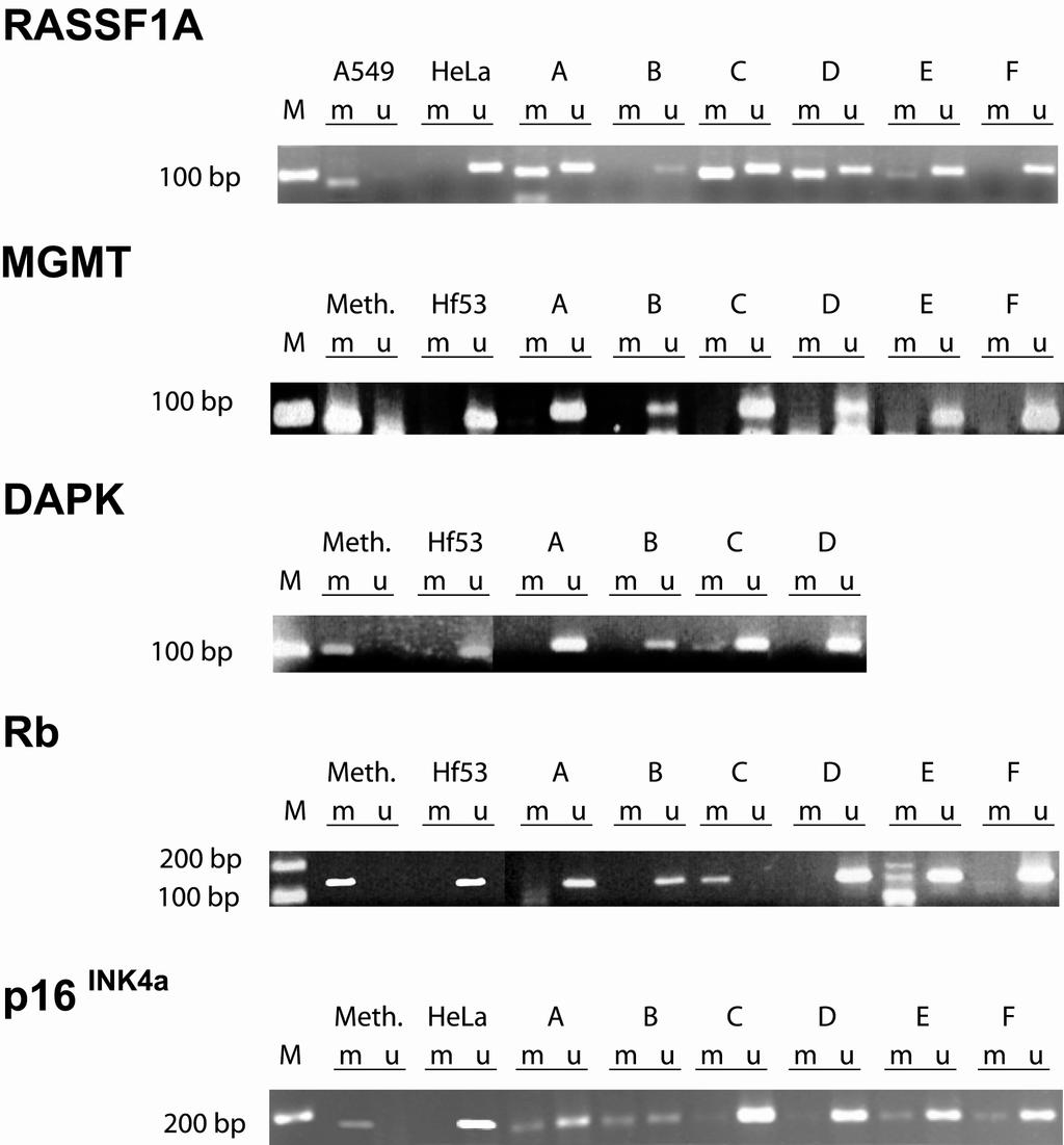 3 Ergebnisse 42 Abbildung 3.2: Darstellung der methylierungsspezifischen PCR (MSP) in einer Metastase für die fünf untersuchten Tumorsuppressorgene RASSF1A, MGMT, DAPK, Rb und p16 INK4a.