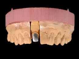 Stumpfe STUMPF: Wird hauptsächlich bei der Anfertigung von festsitzenden Zahnersätzen benötigt (Inlays, Schalen, Kronen, Brücken).