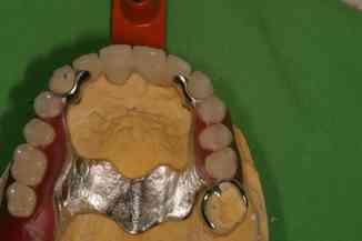 Arbeitsunterlage für den Zahntechniker um einen Zahnersatz herstellen zu