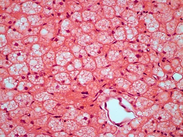 weißes Fettgewebe Fett und Fettzellen braunes Fettgewebe Bilder: Röhlich (univakuoläres / unilokuläres Fett) (multivakuoläres