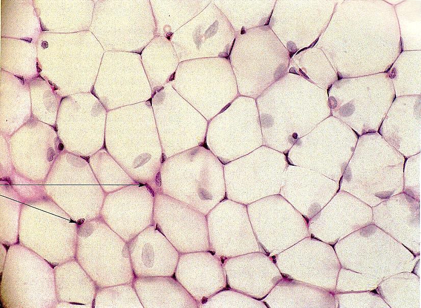 Fasernetz - ein großes Lipidtropfen im Zytoplasm - Zelle groß, siegelringförmig - bei enormer Zunahme erhöht sich auch die