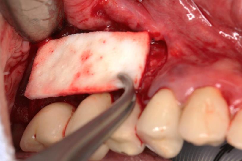 Augmentation der befestigten Gingiva