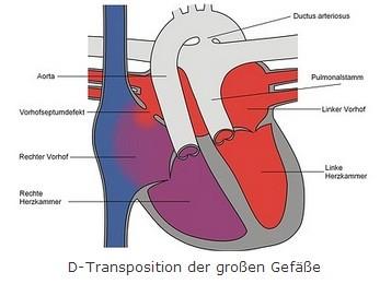 Die komplette Transposition der großen Arterien wird auch als Dextroposition der Aorta, D-TGA, bezeichnet. (19) Die folgende Abbildung zeigt die D-TGA. Abbildung 6: D- TGA (40) 5.2.