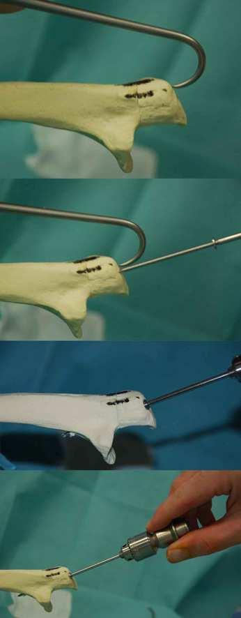 Unterlegscheibe wurde in gleicher Weise und in parallelem Verlauf zum ersten Implantat im Kunstknochen platziert.