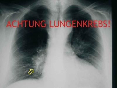 Radon verursacht Lungenkrebs Radon ist nach dem Rauchen die häufigste Ursache für Lungenkrebs Zwischen der Belastung der Lungen und der Krebsentstehung können