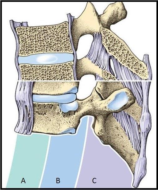 minektomie ist von einer Instabilität der Wirbelsäule auszugehen, wenn Schäden an der mittleren und hinteren Säule vorliegen. Abbildung 3: 3-Säulen-Theorie nach Denis.