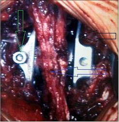 dorsaler Ansicht (Bild aus Firmenmaterial). Abbildung 18: Intraoperative Lage des X-Stop-Implantates.
