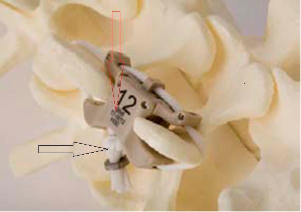 Abbildung 20: Interspinöse Lage des InSWing-Implantates. Die Abbildung zeigt die korrekte interspinöse Lage eines InSWing-Implantates (roter Pfeil) am Modell.